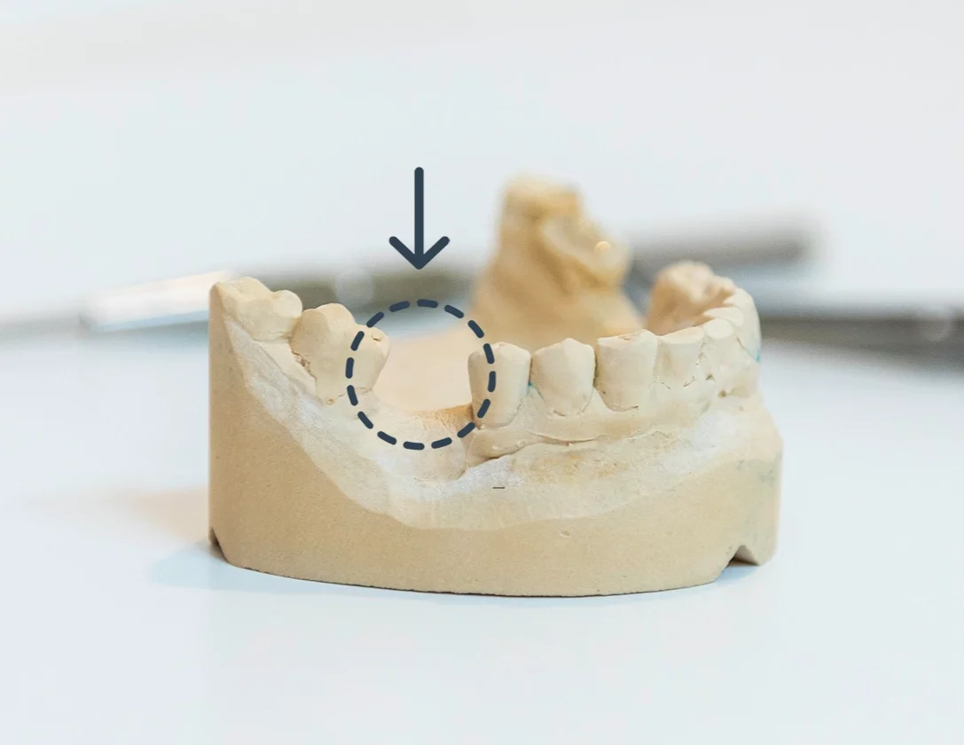 Cuidados del implante dental